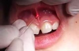laser Dentaire ORL